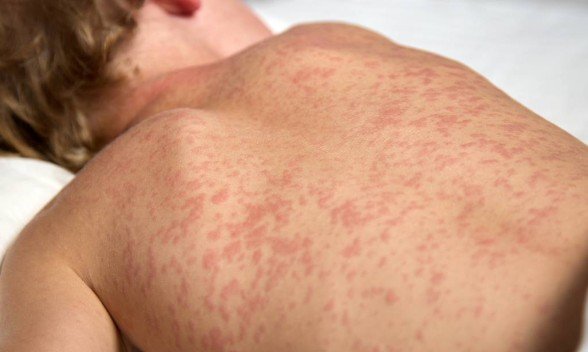 Georgia Confirms Second Measles Case of 2026 in Bryan County Resident